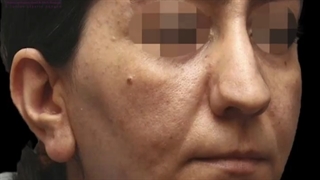 چند هفته بعد از عمل بینی