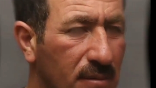 قبل و بعد از لیفت پیشانی و ابرو در مراجعه کننده عزیزمون