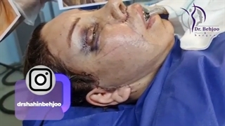 لیفت کامل صورت و پیشانی