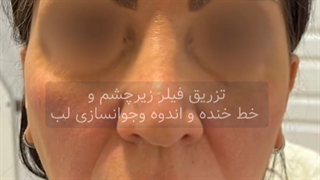 فیلم تزریق فیلر زیر چشم لیفت صورت