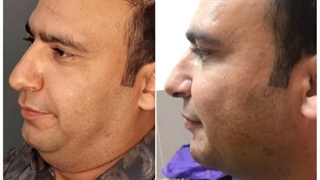 ساکشن غبغب