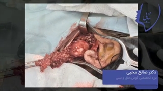 فیلم جراحی تومور لوب عمقی پاروتید