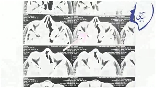 فیلم جراحی سینوس