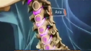 بیرون زدگی دیسک گردن به چه دلیل اتفاق می افتد؟