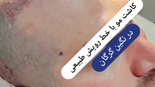 کاشت مو با تراکم بالا در گرگان و استان گلستان