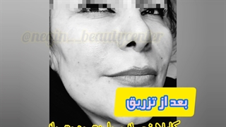 تزریق فیلر خط خنده (ژل و چربی ) در گرگان ۰۹۳۳۶۰۹۳۰۰۰ اکستنشن تاج دندان