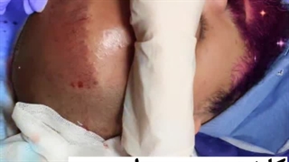 عمل زیبایی کاشت مو در گرگان بدون جراحی