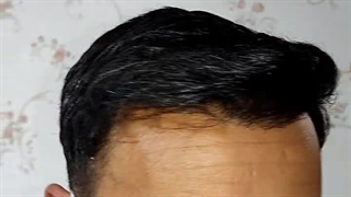 نتیجه کاشت مو در گرگان(۸ ماه بعد ) ۰۹۳۳۶۰۹۳۰۰۰