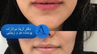 نتیجه تزریق فیلر لب!!!
