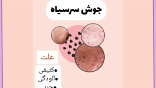 انواع جوش صورت و راهکارهایی معجزه آسا برای درمان آن