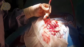 فیلم واقعی و بدون سانسور جراحی موفقیت آمیز تومور مغزی