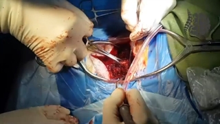 فیلم واقعی و بدون سانسور جراحی تنگی کانال نخاعی گردن