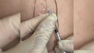 اکتازی های ولولار عروق تلانژکتازی ارغوانی - واریس عنکبوتی