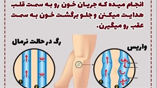 با هم ببینیم چی میشه که واریس توی پا ایجاد میشه ؟