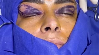 بهترین زمان برای بلفاروپلاستی