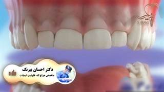 چگونگی روند درمان لیفت لثه را در این ویدیو میتوانید ببینید
