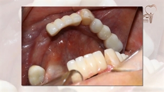 درمان بازسازی کامل دهان با تکنیک ایمپلنت دیجیتال و روکش تمام سرامیک