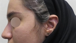 نمونه ای از فیلم واقعی جراحی بینی گوشتی