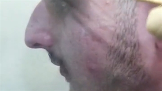 رینوپلاستی بینی استخوانی