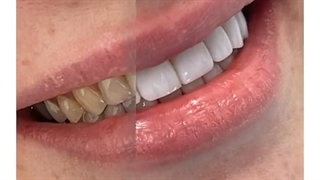 کامپوزیت ونیر ده دندان فک بالا و ده دندان فک پایین با رنگ سفید صدفی