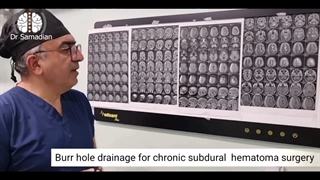 ‎عمل جراحی تخلیه ی هماتوم مغزی مزمن (ساب دورال مزمن) در یک بیمار مسن