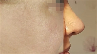 نتیجه جراحی بینی 8 ماه بعد از جراحی