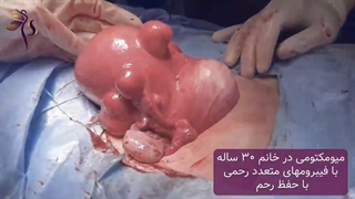 جراحی میومکتومی در خانم 30 ساله