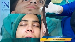 بلافاصله بعد از جراحی بینی مردانه