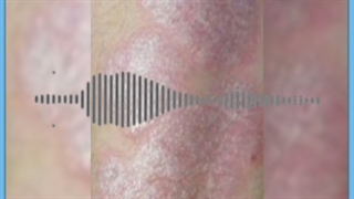 همه آنچه باید درباره پسوریازیس و درمان آن بدانید