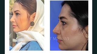 جراحی رینوپلاستی