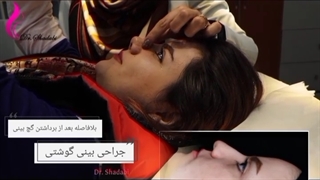 بالافاصله بعد از درآوردن گچ بینی