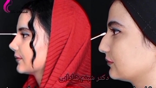 یک ماه بعد از عمل بینی