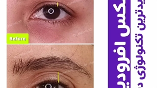 جوانسازی فوری پلک بدون جراحی با بهترین تکنولوژی دنیا