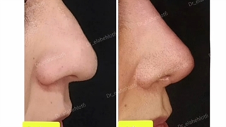 فیلم تزریق فیلر بینی