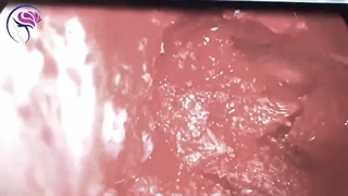 فیلم بدون سانسور جراحی تومور سینوس