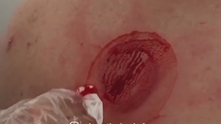 رضایت از حجامت