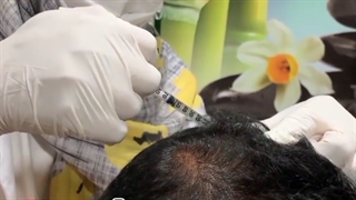 مزوتراپی مو