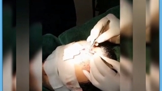 خونریزی بعد از کاشت مو