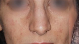 جراحی زیبایی بینی به همراه اصلاح انحراف