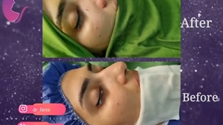 فیلم واقعی و بدون سانسور از عمل بینی