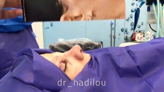 جراحی بینی گوشتی به سبک طبیعی