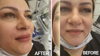 تزریق فیلر لب و فیلر خط خنده
