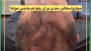 درمان ریزش موی ژنتیکی یا ارثی مردان و انواع الگوی طاسی مردانه