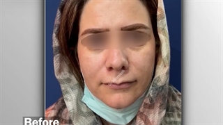 جراحی لیفت لب | دکتر خوروش