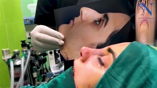 پایان عمل جراحی و مقایسه ی قبل و بعد از عمل بینی