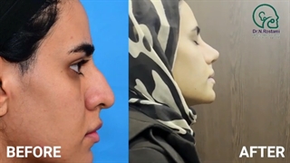 یک ماه بعد از جراحی بینی گوشتی با انحراف