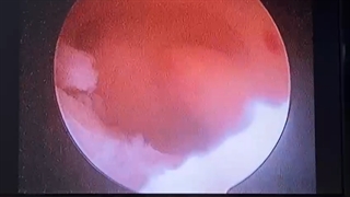 جراحی پولیپکتومی به وسیله هیستروسکوپ