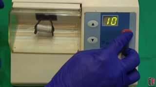 کاهش آسیب های ایاتروژنیک با کاربرد کپسول گلاس آینومر نوری