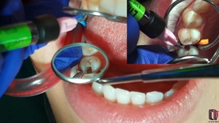 قراردهی محدود دایکال نوری در تکنیک IPC