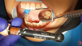 تکنیک کاربرد همزمان کامپوزیت فلو همراه با یک کامپوزیت conventianal